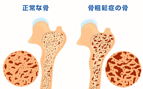 骨粗しょう症